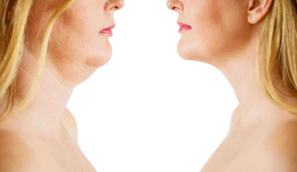 Double Chin treatment Sunbury-on-Thames before and after results