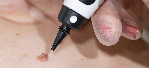 After Skin Tag Removal Sunbury-on-Thames