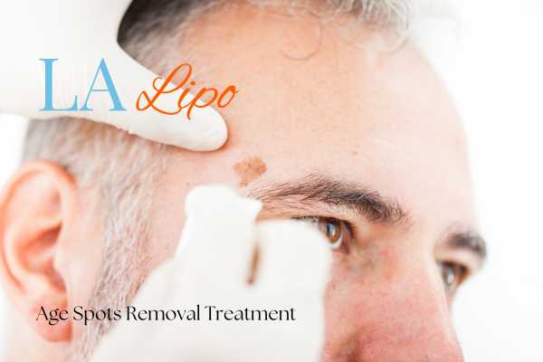 What Are the Most Effective Treatments for Age Spots Sunbury-on-Thames?
