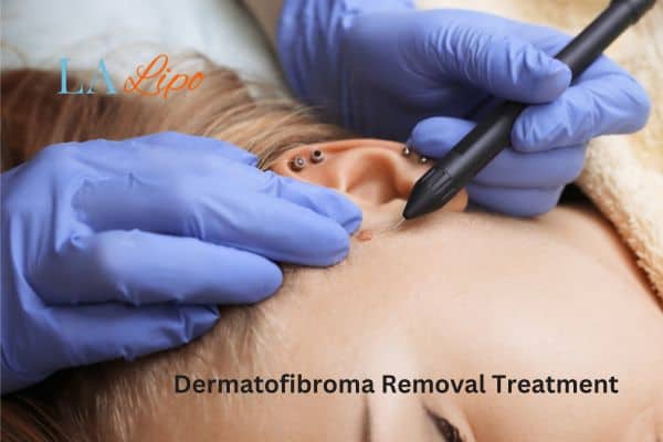 Dermatofibroma Removal Treatment Sunbury-on-Thames