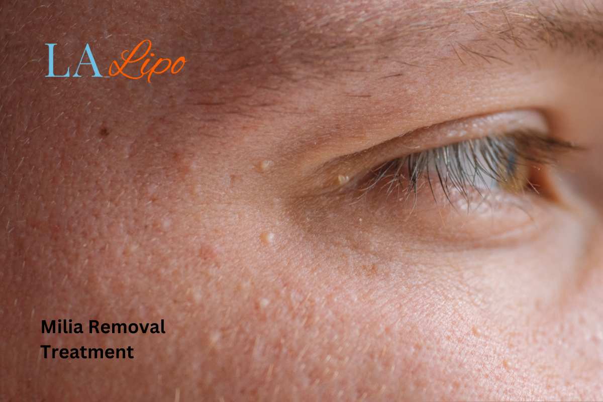 Cryopen Milia Removal: Is It the Easiest and Safest Option Sunbury-on-Thames?
