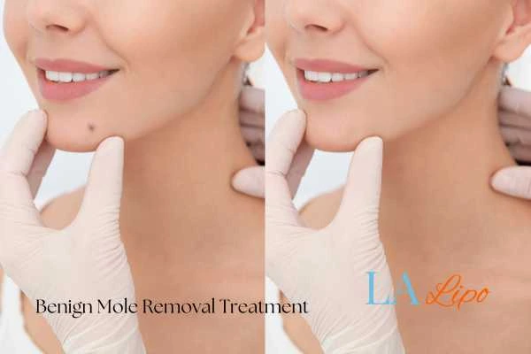 woman's before and after mole removal Sunbury-on-Thames results