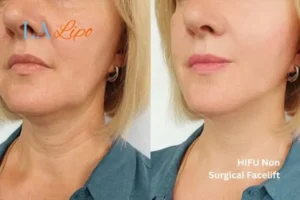 hi-fu for wrinkles Sunbury-on-Thames before and after results