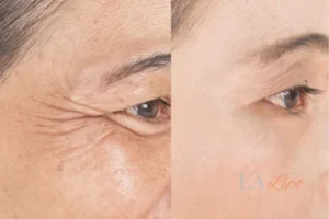 Before and after results of woman - HI-fu wrinkles reduction treatment Sunbury-on-Thames