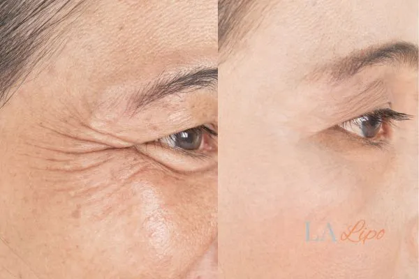 Before and after results of woman - HI-fu wrinkles reduction treatment Sunbury-on-Thames
