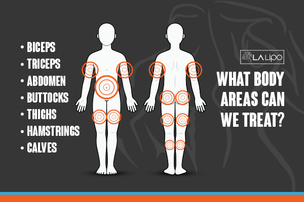 Graphic to show areas you can have LA-EMS Body Sculpting Sunbury-on-Thames treatment.