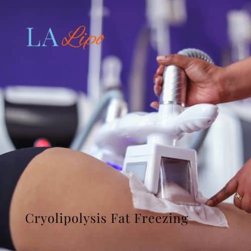 fat freezing - Cryolipolysis Sunbury-on-Thames