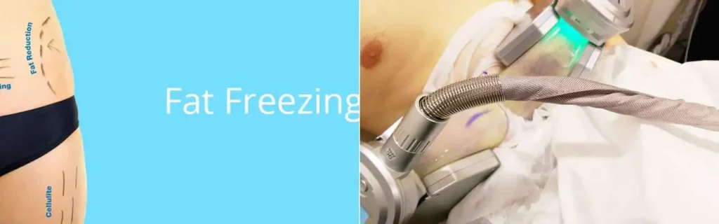 Fat freezing Sunbury-on-Thames on multiple areas of the body