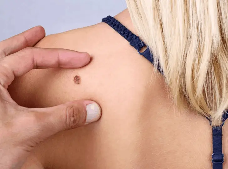 woman having mole removal Sunbury-on-Thames consultation before treatment.