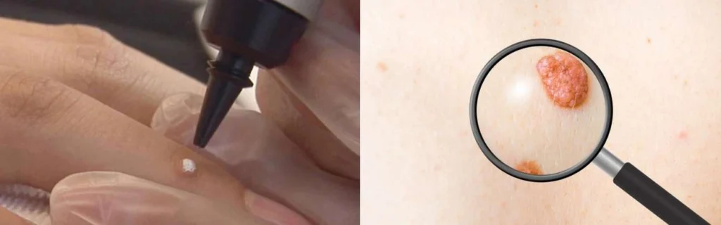 CryoPen practitioner Sunbury-on-Thames assessing a benign mole before treatment