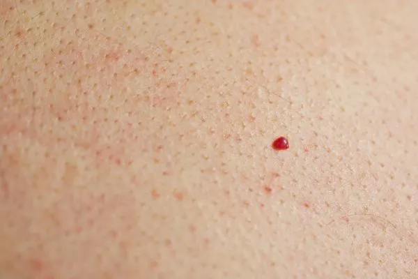 close up of a cherry angioma Sunbury-on-Thames