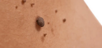 image of a skin tag Sunbury-on-Thames