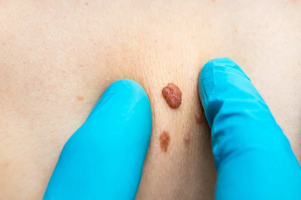 Consultant examining a skin tag Sunbury-on-Thames