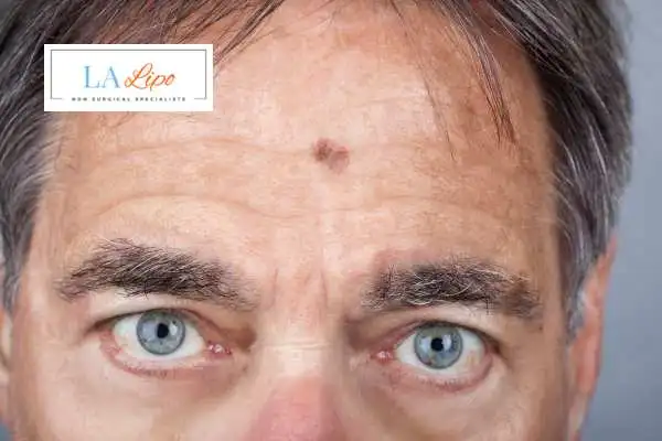Solar Lentigo Removal Sunbury-on-Thames image of man with mark on his forehead