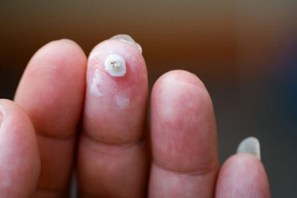 wart on person finger - cryotherapy to treat from LA LIPO Sunbury-on-Thames