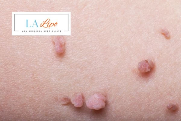 Does cryopen skin tag removal Sunbury-on-Thames hurt? Find out now call our team today!