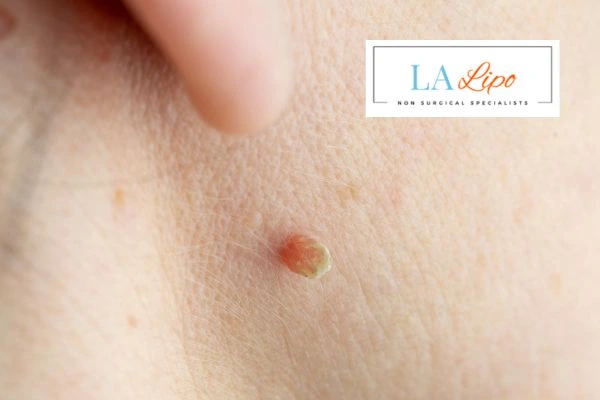 Book skin tag removal Sunbury-on-Thames today speak to our team now!