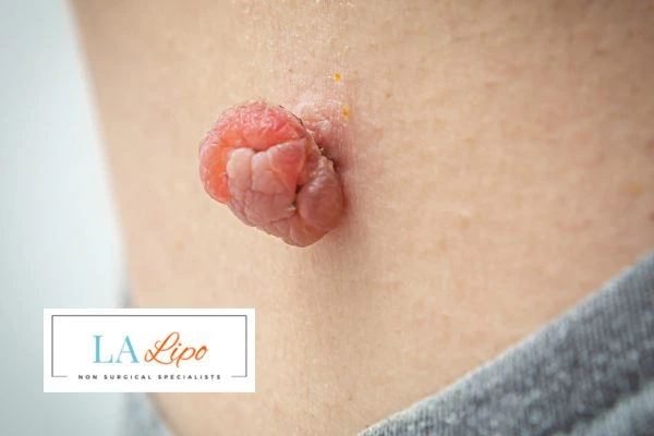 Interested in skin tag removal Sunbury-on-Thames? Concerned about the pain? Find out more today!