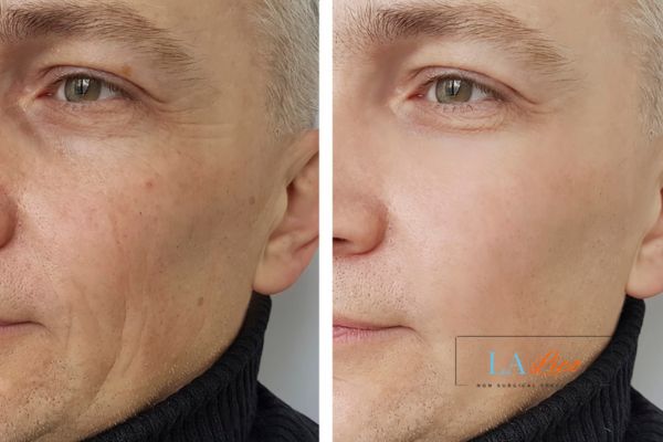 See the amazing results of Morpheus8 Treatment Sunbury-on-Thames!