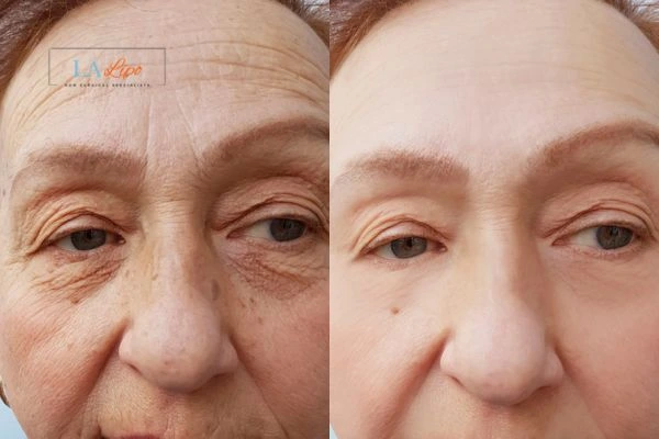 The powerful benefits of Morpheus8 Treatment Sunbury-on-Thames - Call Our team today!