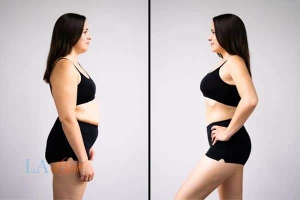 Picture of womans before and after using LA-EMS body sculpting to improve her core strength Sunbury-on-Thames
