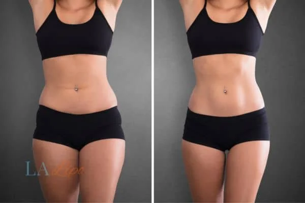 before and after results of non-surgical treatment to help a woman's body image and mental health Sunbury-on-Thames