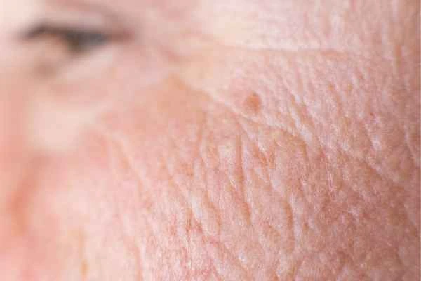 close up picture of a woman's face showing an age spot Sunbury-on-Thames