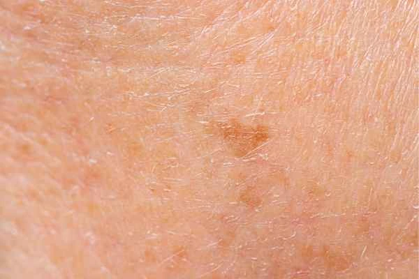 close up picture of age spots Sunbury-on-Thames