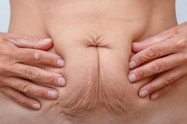 Image of a woman's stomach with loose skin - example of skin tightening Sunbury-on-Thames options