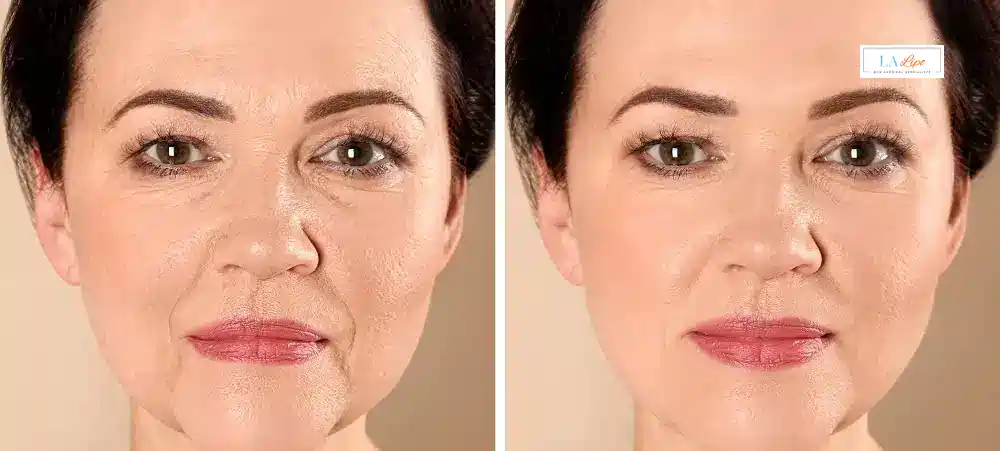 How Long Does It Take to See Results and How Long Do They Last Sunbury-on-Thames?
