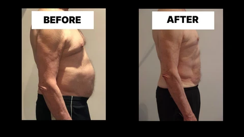 What Symptoms Can Diastasis Recti Cause in Men? Weak Core, Back Pain and Poor Posture Sunbury-on-Thames